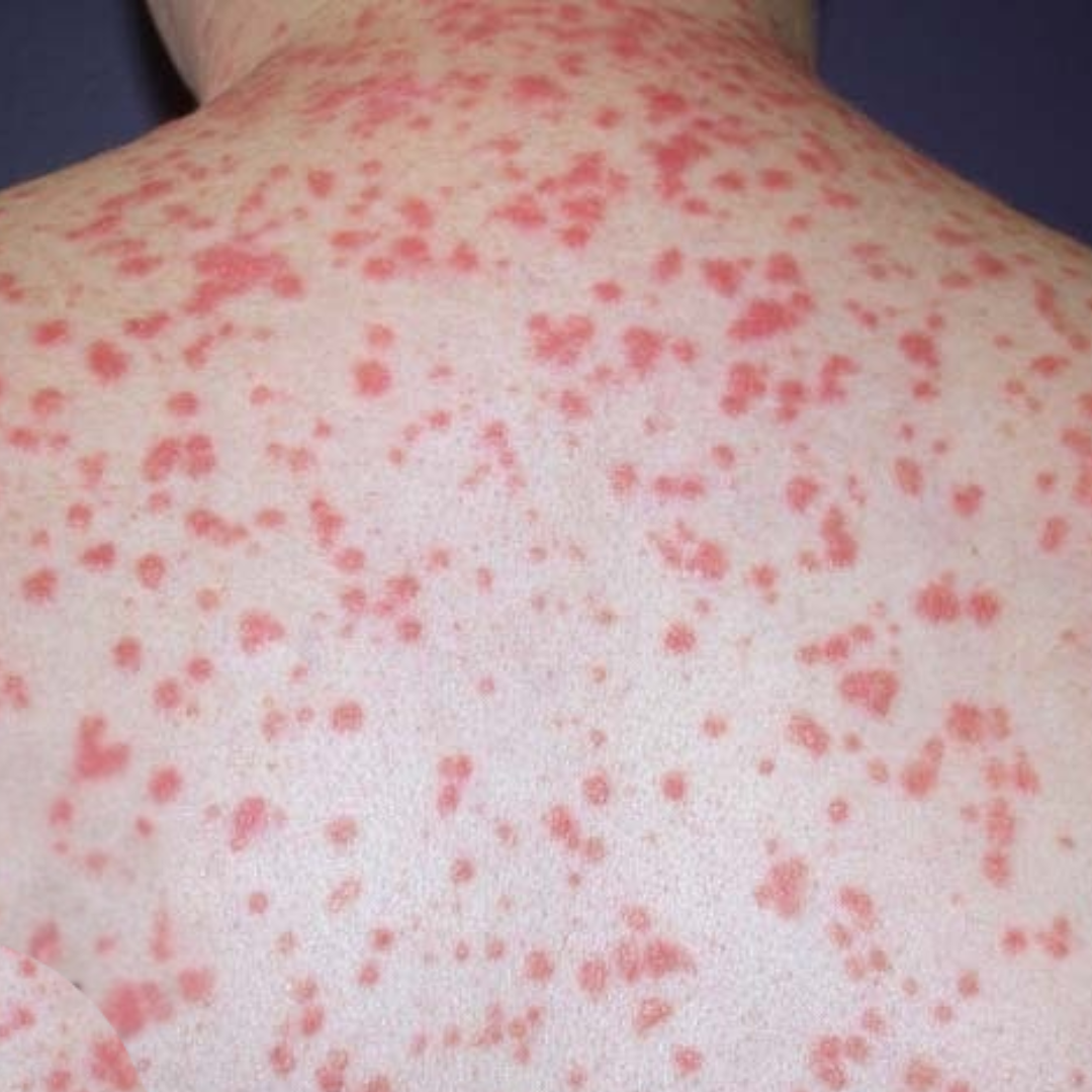 Apa itu psoriasis guttate?