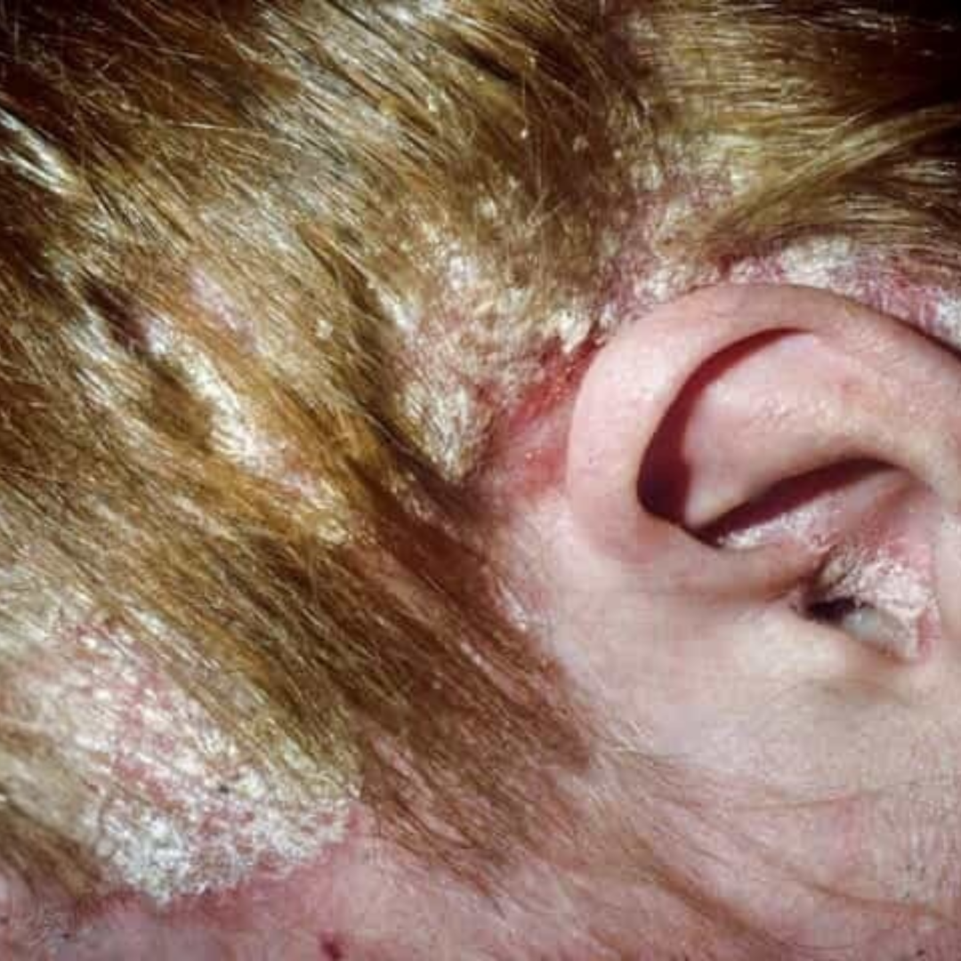 Psoriasis Pada Kulit Kepala