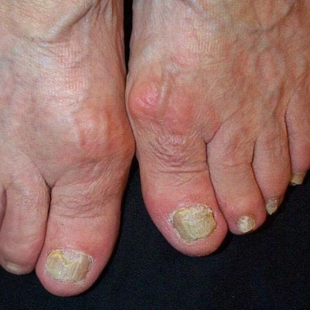 Apa itu psoriasis kuku?