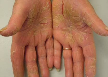 Psoriasis pada telapak tangan dan telapak kaki