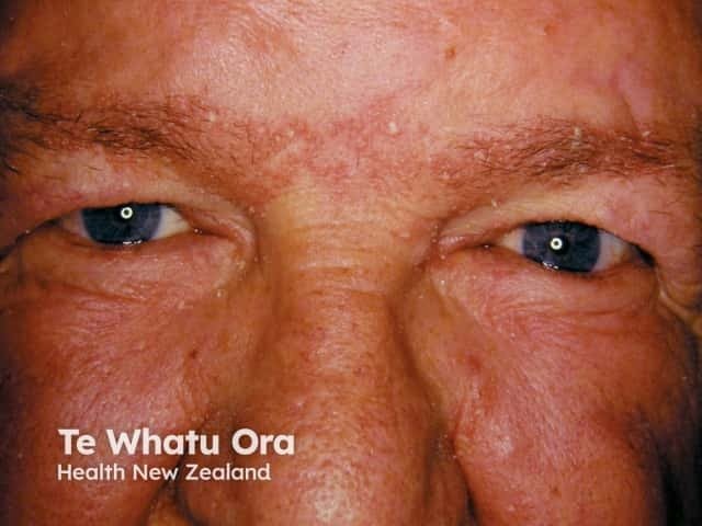 Psoriasis Pada Wajah?