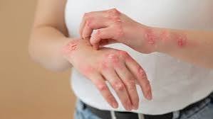 Pengobatan Psoriasis Hingga Saat Ini