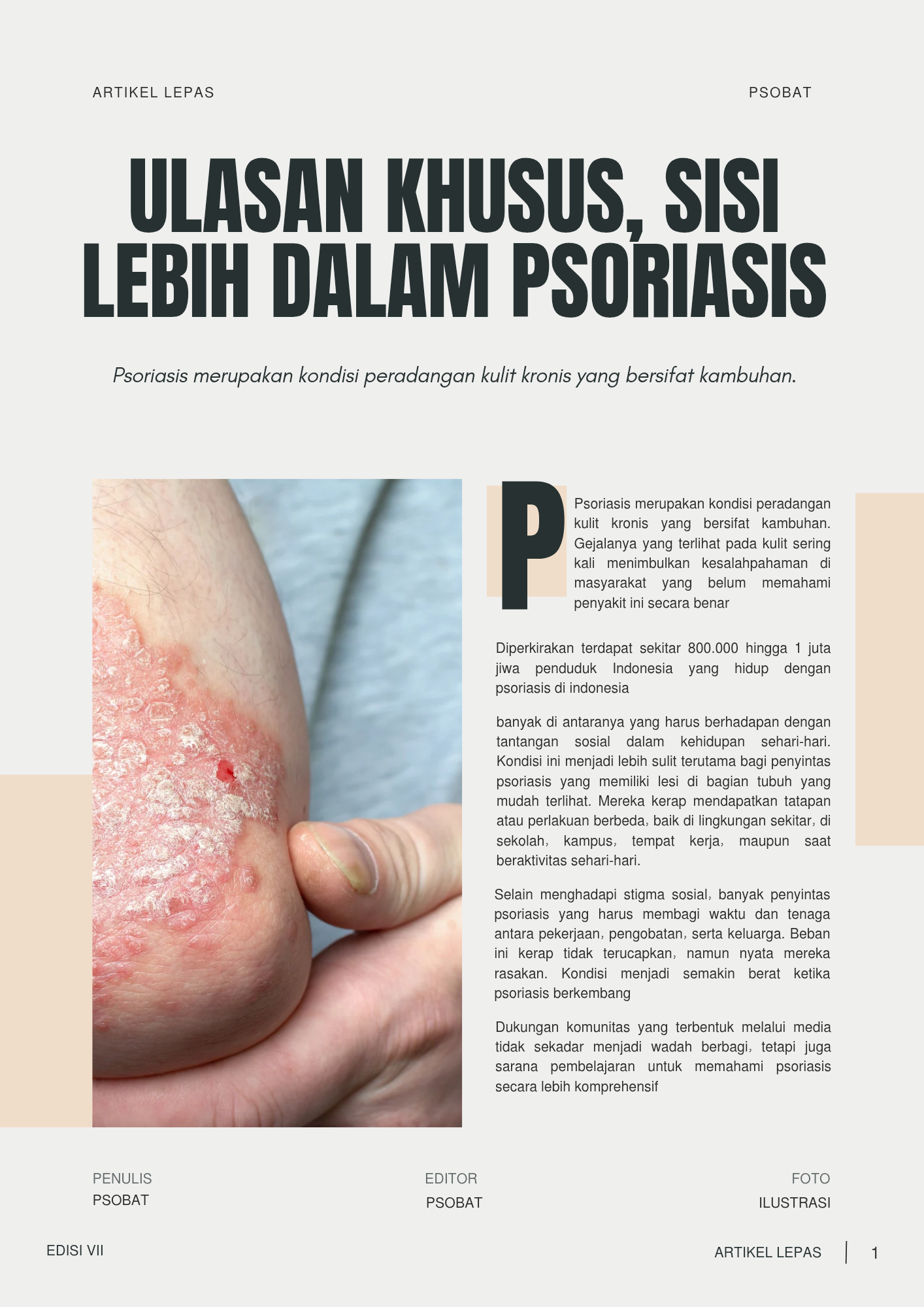 psoriasis