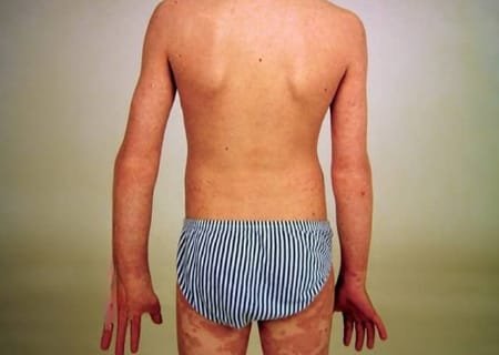 Psoriasis pada Anak (Paediatric Psoriasis)