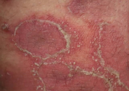 Psoriasis pustular pada kehamilan