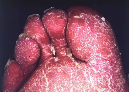 Psoriasis Eritrodermik