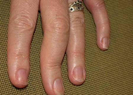 Artritis Psoriatik (Psoriatic Arthritis, PsA)