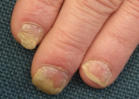 Dampak Psikologis Psoriasis