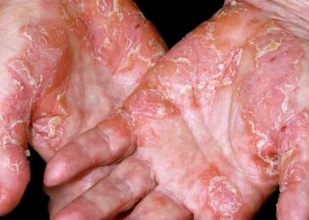 Pengobatan dan Managemant Psoriasis